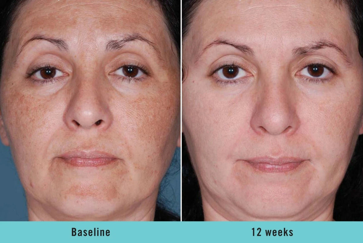Kojic Acid Brightening Serum – Dark Spot Corrector